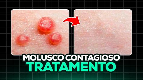 como eliminar molusco contagioso naturalmente|Molusco Contagioso: 12 Tratamentos Caseiros,。